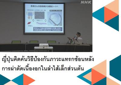 ญี่ปุ่นคิดค้นวิธีป้องกันภาวะแทรกซ้อนหลังการผ่าตัดเนื้องอกในลำไส้เล็กส่วนต้น