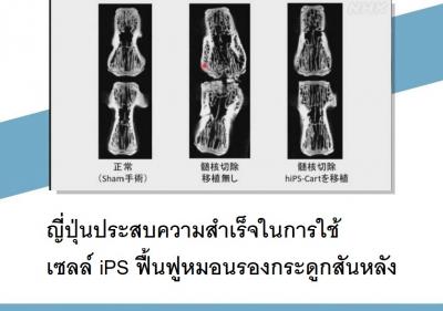 ญี่ปุ่นประสบความสำเร็จในการใช้เซลล์ iPS ฟื้นฟูหมอนรองกระดูกสันหลัง